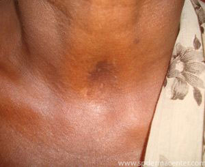 Vitiligo-After